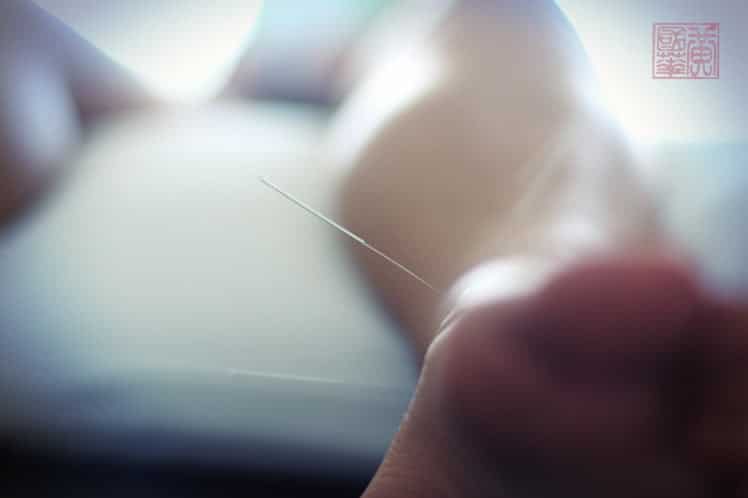First acupuncture session needle